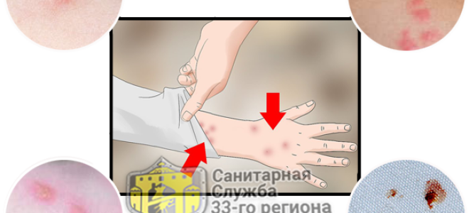 Как кусают клопы человека постельные