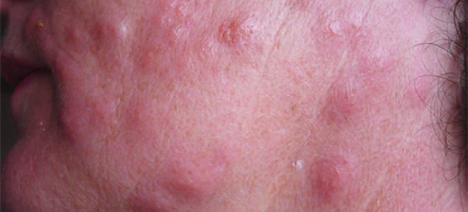 Как лечить укусы клопов у человека