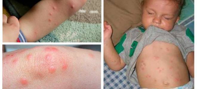 Как выглядит укус клопа на теле ребенка