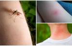 Как отличить укус комара от укуса клопа у ребенка