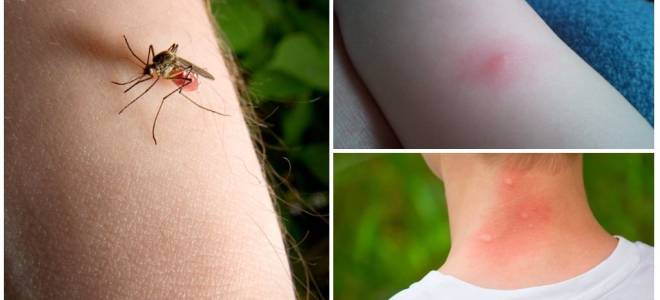 Как отличить укус клопа от укуса мошки