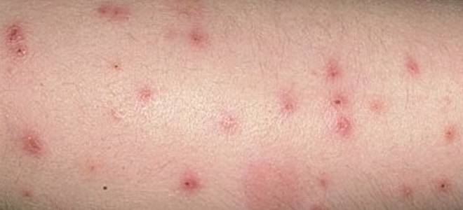 Клопы что переносят