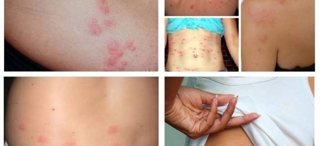 Как узнать есть ли клопы постельные