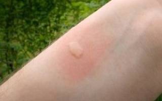 Чем ребенку помазать укус комара