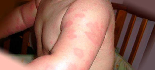 Клопы покусали ребенка что делать