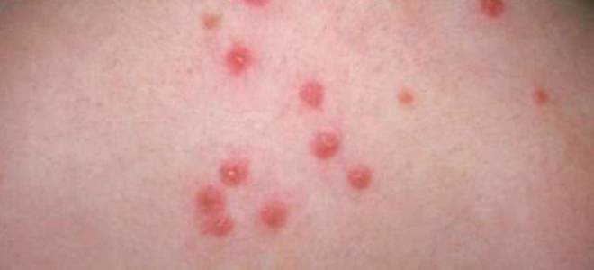 Как отличить укус блохи от укуса клопа