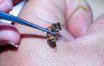 Лечение укусы пчел