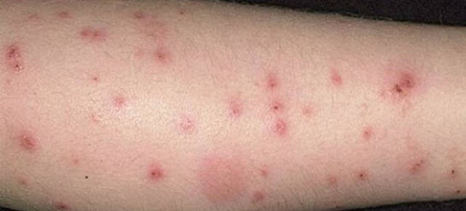 Чем отличается укус клопа от укуса комара