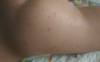 Аллергия как укусы комаров