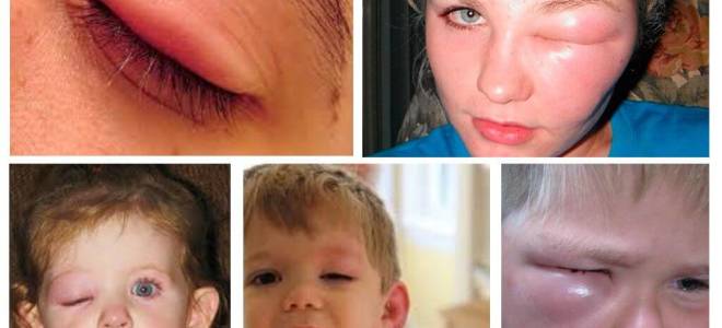 Глаз в укус мошки